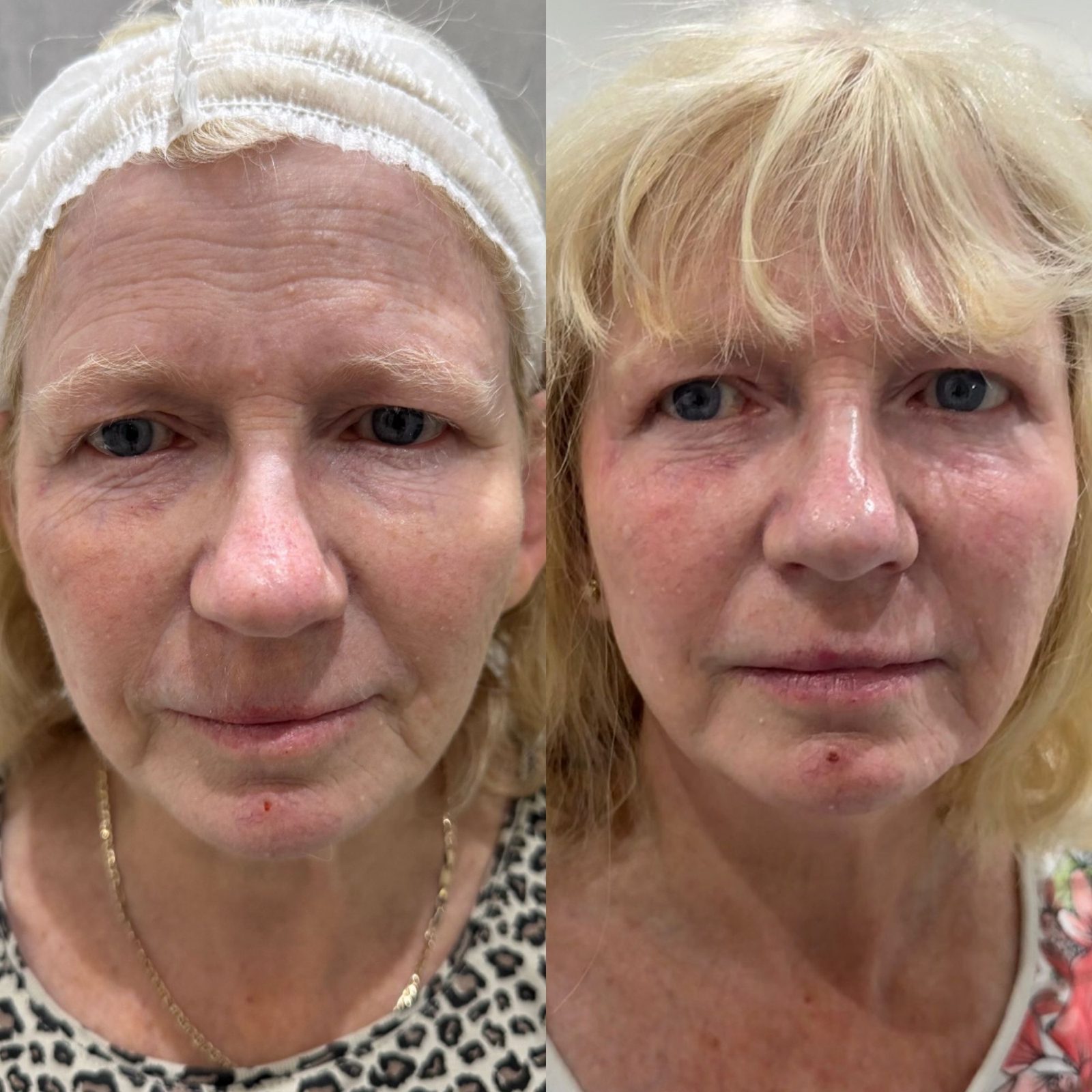 Skin by Dr Caroline NeoGen patient, before and after, full face