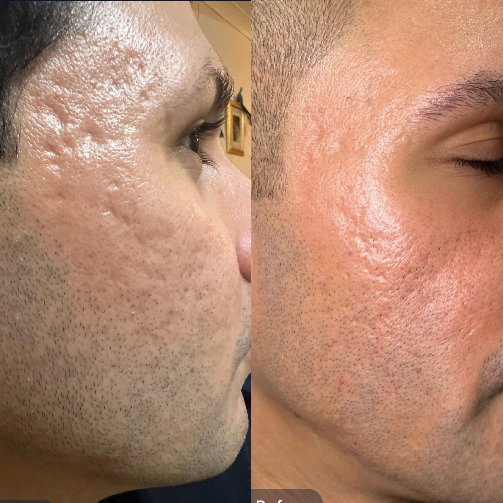 Skin by Dr Caroline NeoGen patient, before and after, acne scarring