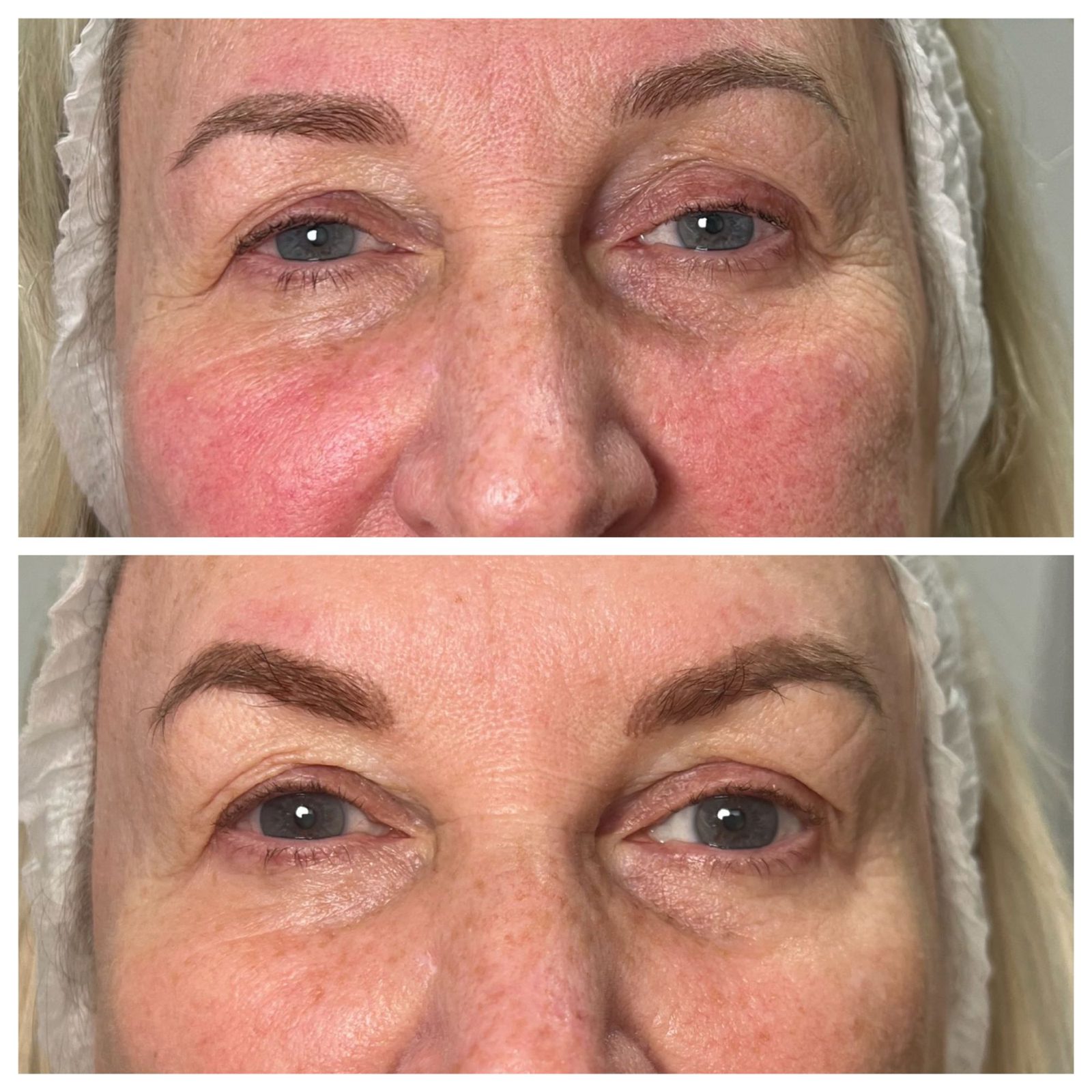 Skin by Dr Caroline NeoGen patient, before and after, eye area