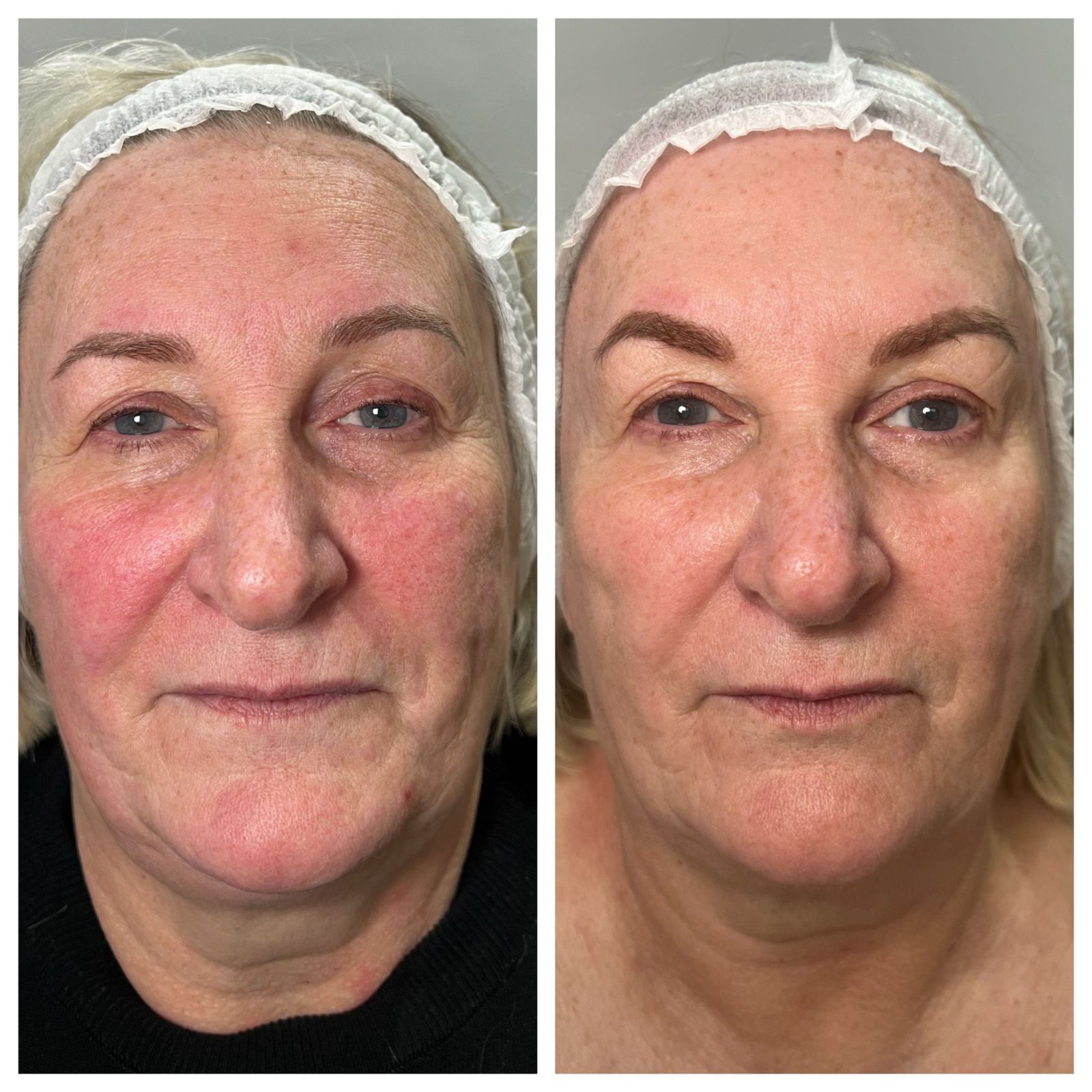 Skin by Dr Caroline NeoGen patient, before and after, full face