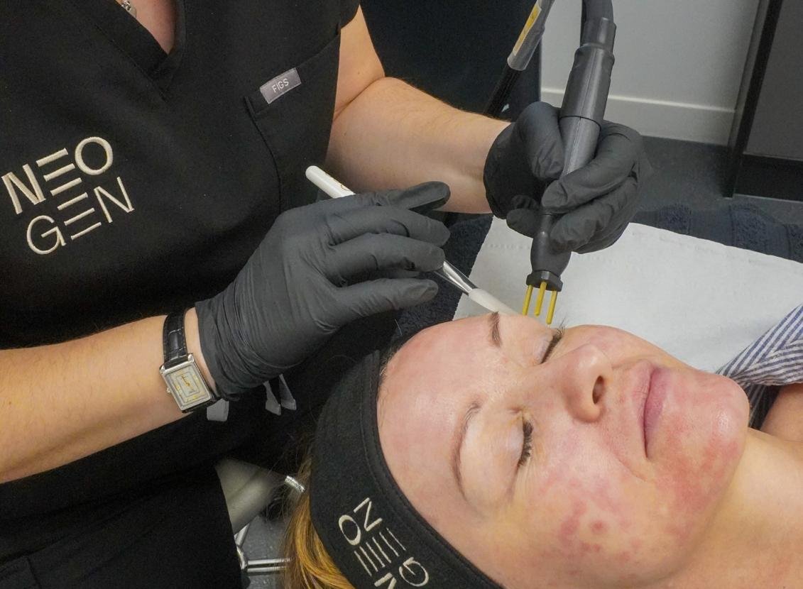 A NeoGen nitrogen plasma treatment around the eye area